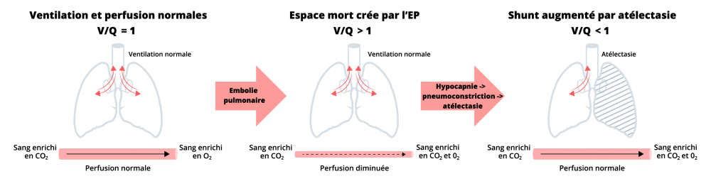 Embolie pulmonaire - Physiopathologie | Cœur / Poumons