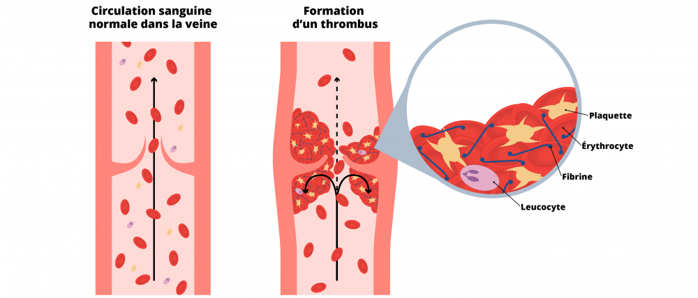 Thromboembolie Veineuse Physiopathologie C ur Poumons M tabolisme Thromboembolie Veineuse Physiopathologie C ur Poumons M tabolisme